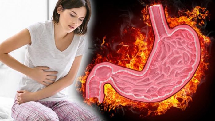 Gastrite Ne İyi Gelir? Gastrit Nasıl Geçer