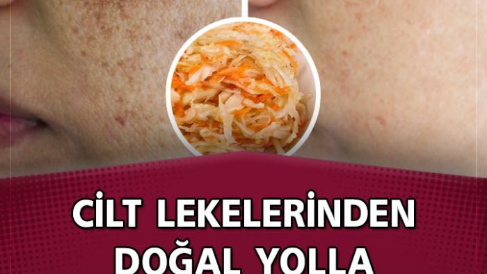 Cilt Lekelerinden Doğal Yolla Kurtulmak İçin 7 Uzman İpucu